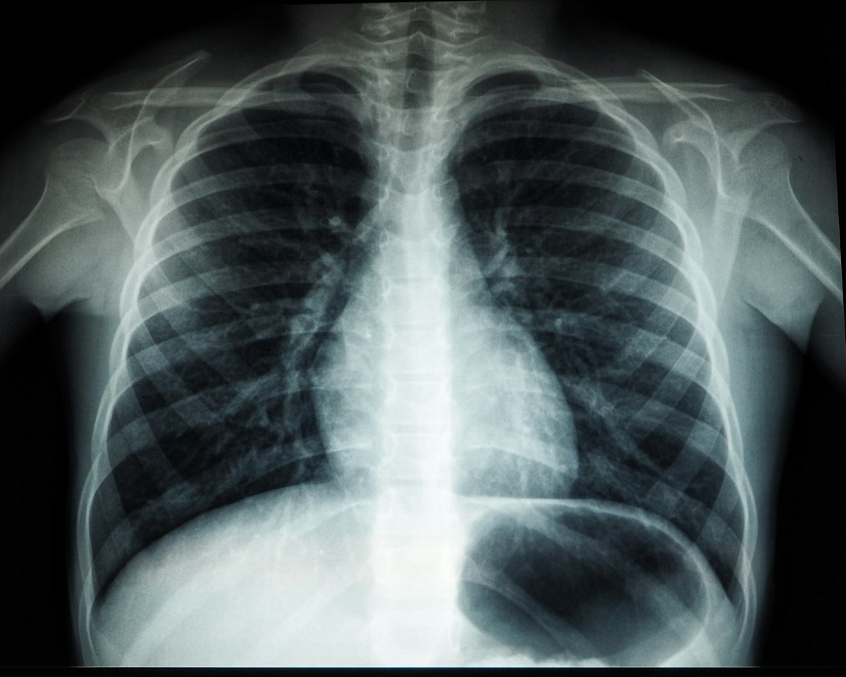 Spine X-ray